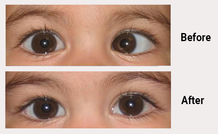 Expert Strabismus Treatment - Baath Eye Care Centre